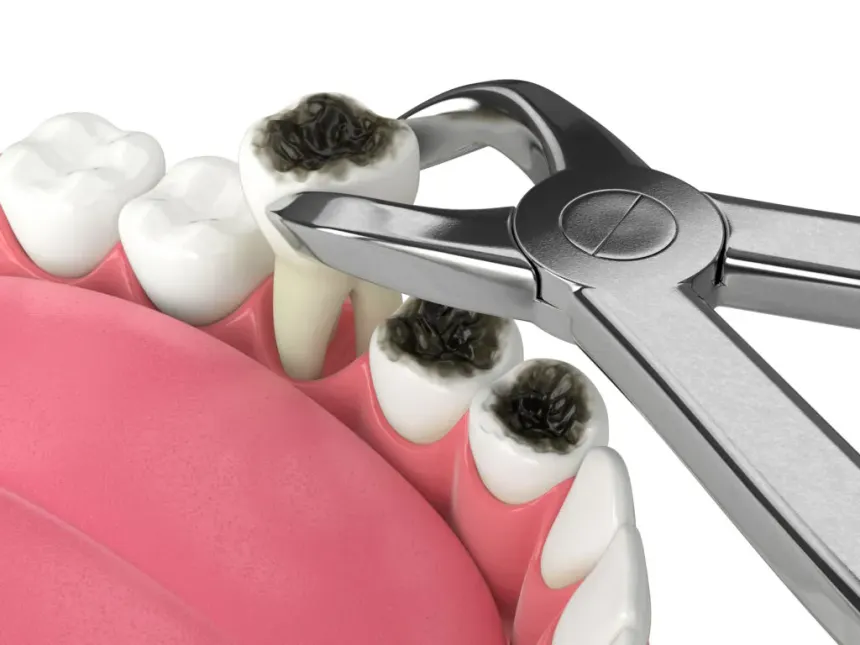 Tooth Extraction in Jabalpur