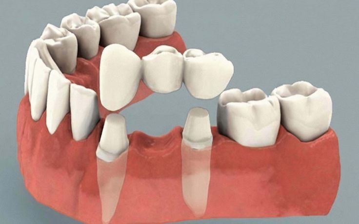 Dental crowns and bridges service in Jabalpur for tooth restoration