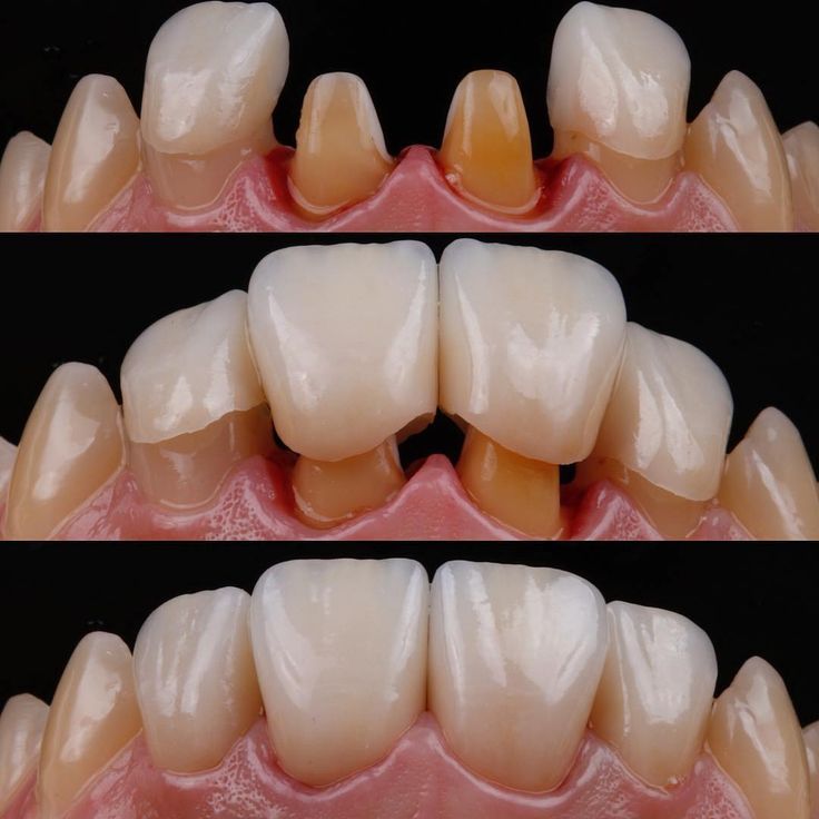 Dental crown in jabalpur