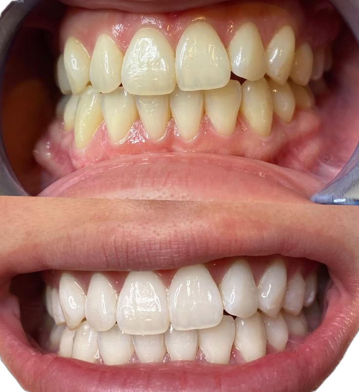 Teeth whitening in jabalpur