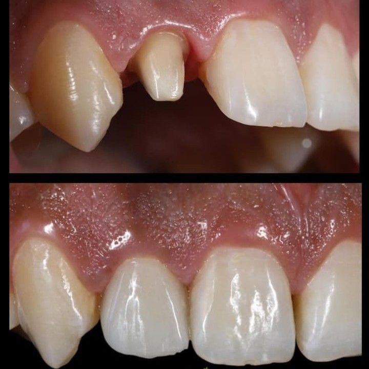 Dental crown in jabalpur