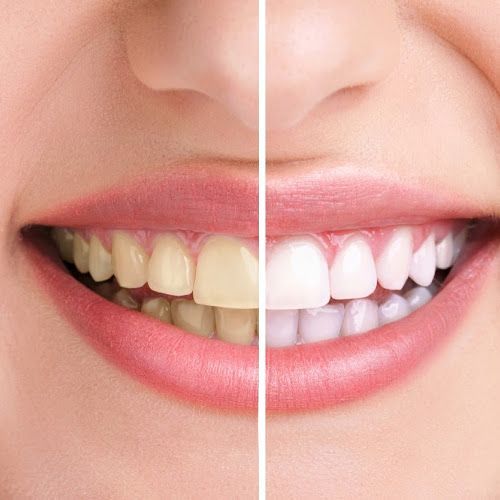 Teeth whitening in jabalpur