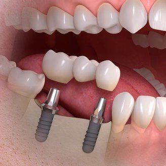 Dental implant in jabalpur
