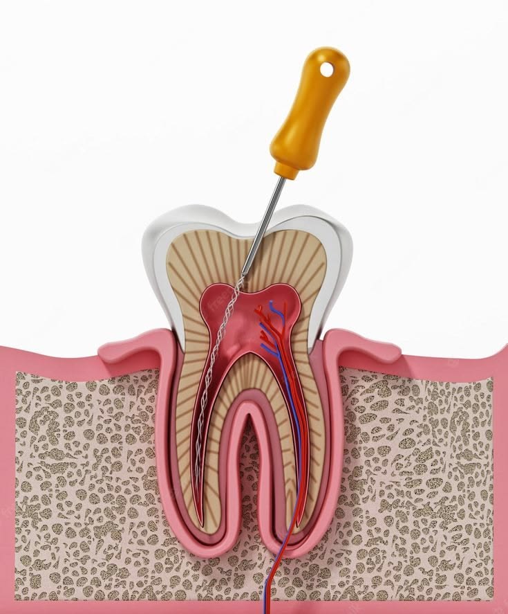 Root canal treatment in jabalpur