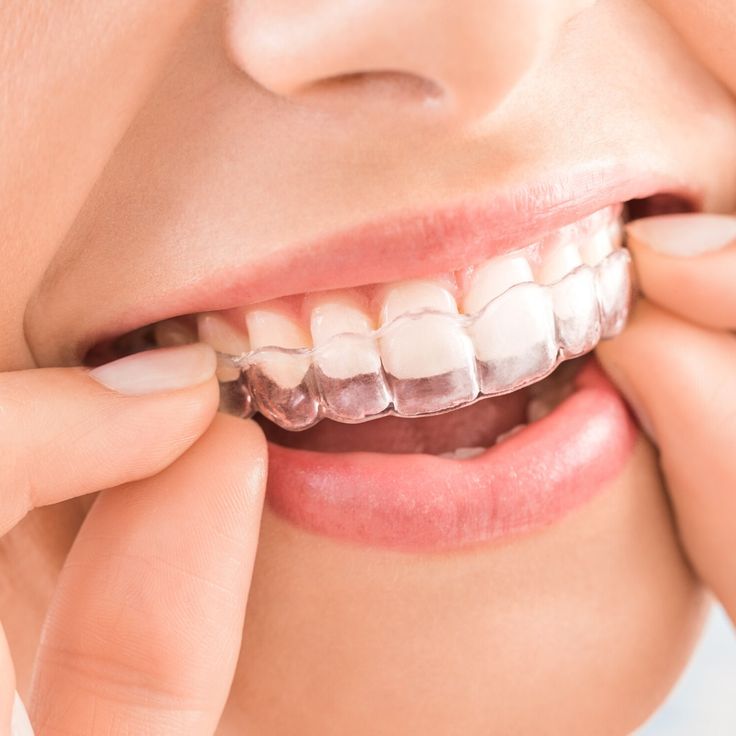 Braces and Aligners in Jabalpur