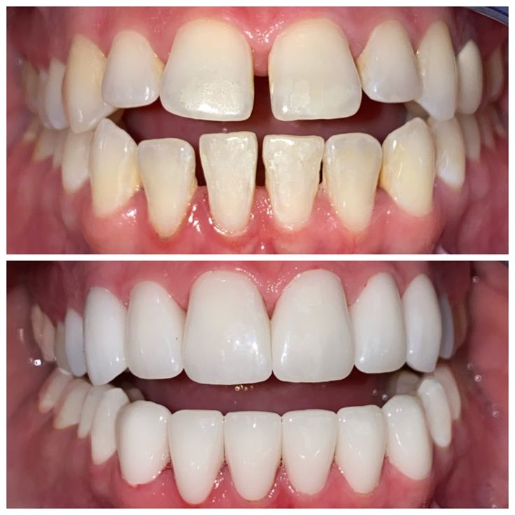 Smile Makeover in Jabalpur