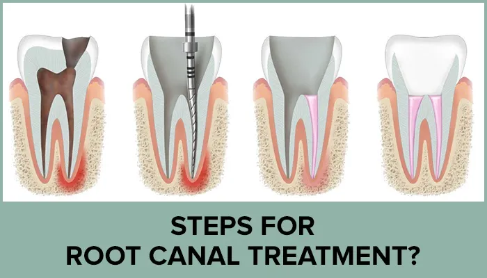 Root canal treatment in jabalpur