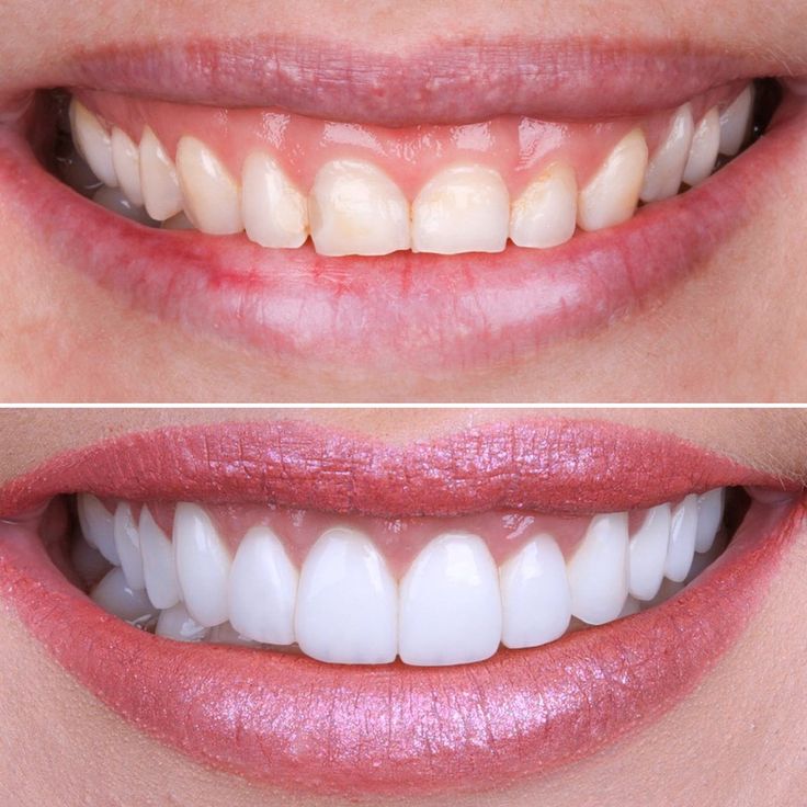 Smile Makeover in Jabalpur
