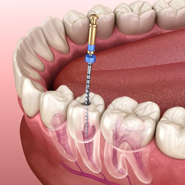 Root canal treatment in jabalpur