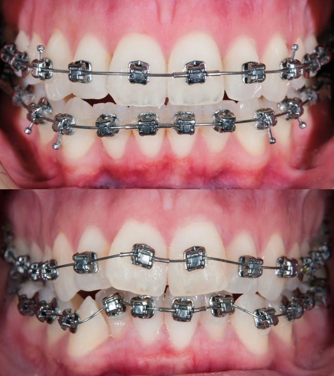 Braces and Aligners in Jabalpur