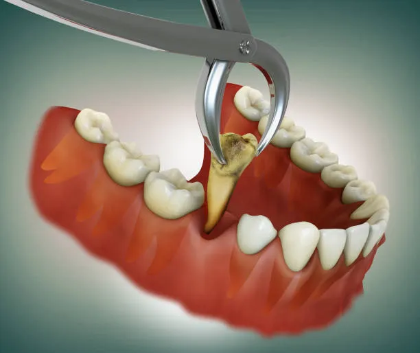 Tooth Extraction in Jabalpur