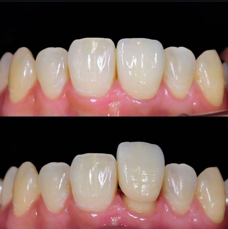 Dental crown in jabalpur