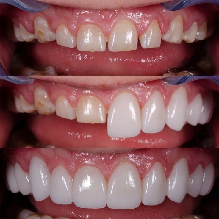Smile Makeover in Jabalpur
