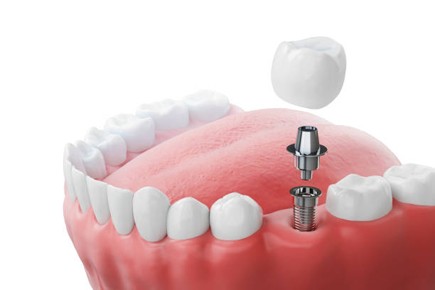 Dental implant treatment at Anuraag Dental Care & Implant Centre in Jabalpur