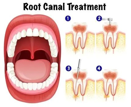 Root canal treatment in jabalpur