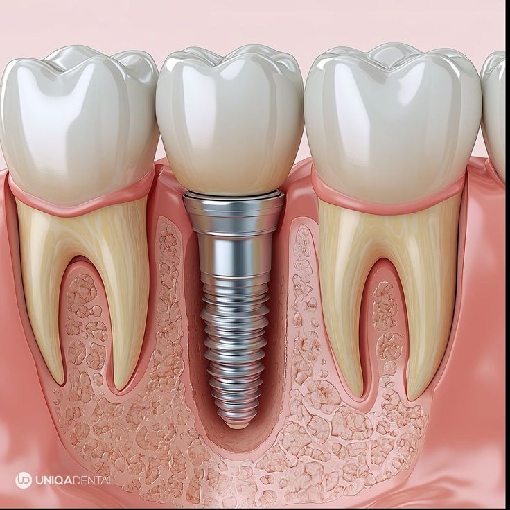 Dental implant in jabalpur